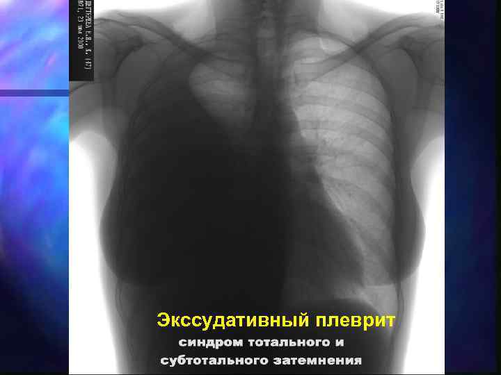 Экссудативный плеврит 