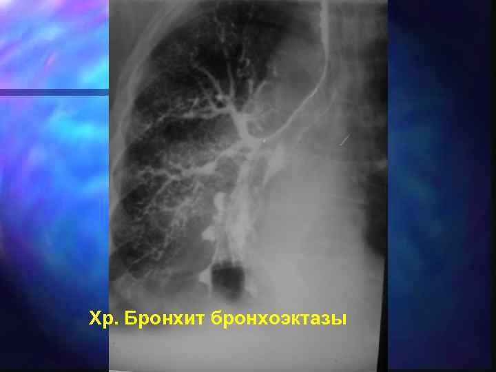 Хр. Бронхит бронхоэктазы 