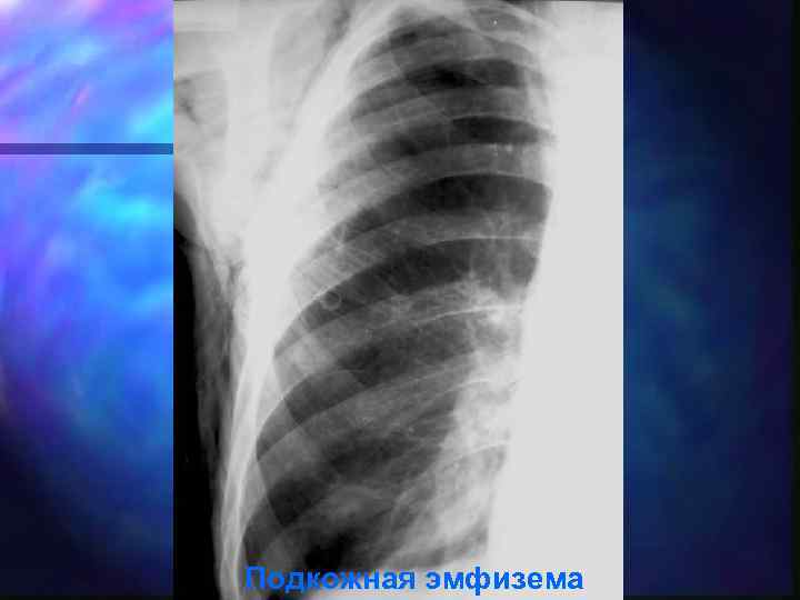 Подкожная эмфизема 