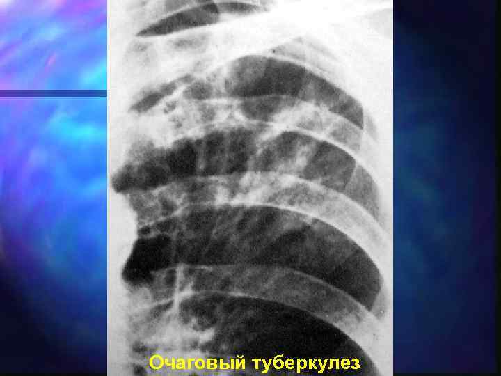 Очаговый туберкулез 