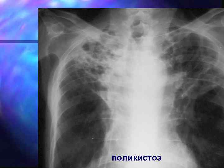 поликистоз 
