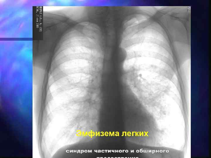 Эмфизема легких 