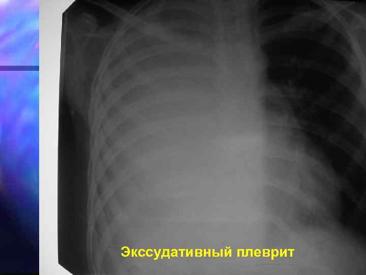 Экссудативный плеврит 