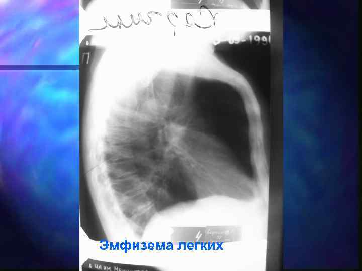 Эмфизема легких 
