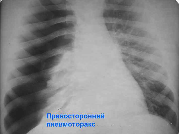 Правосторонний пневмоторакс 