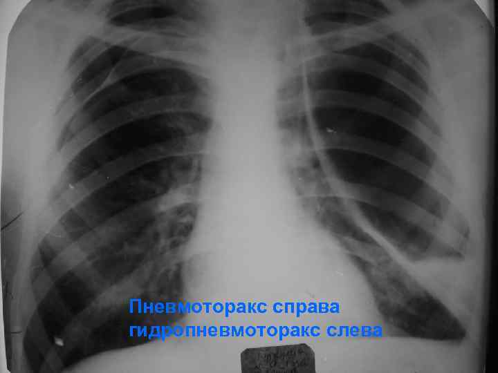 Пневмоторакс справа гидропневмоторакс слева 