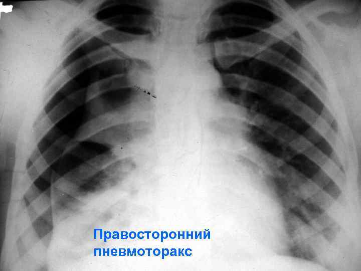 Правосторонний пневмоторакс 