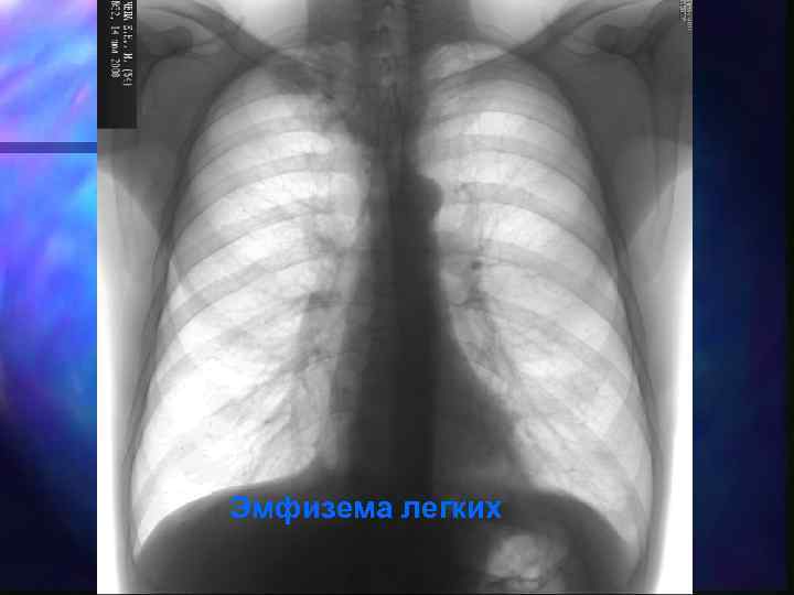Эмфизема легких 