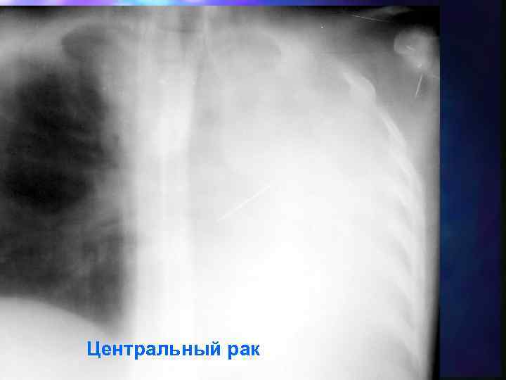 Центральный рак 
