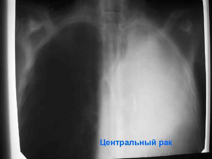 Центральный рак 