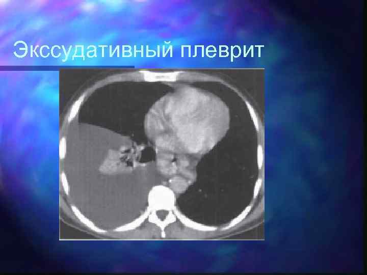 Экссудативный плеврит 