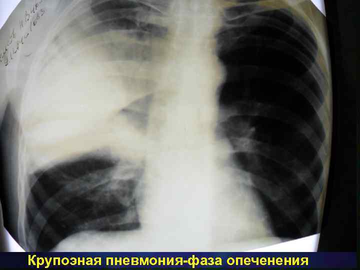 Крупоэная пневмония-фаза опеченения 