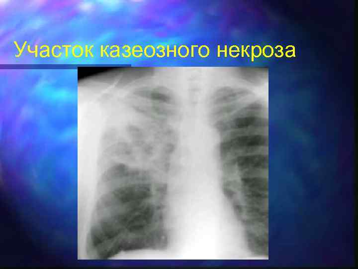 Участок казеозного некроза 