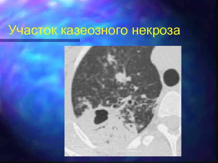 Участок казеозного некроза 