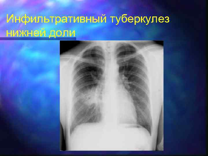 Инфильтративный туберкулез нижней доли 