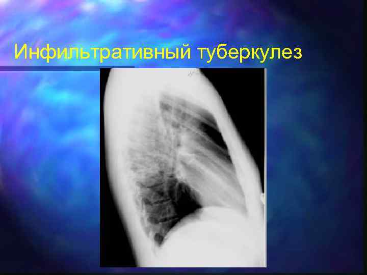 Инфильтративный туберкулез 