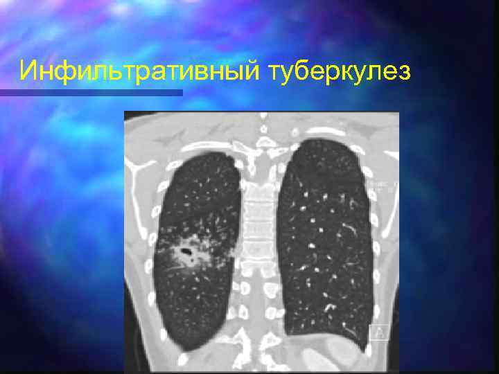 Инфильтративный туберкулез 