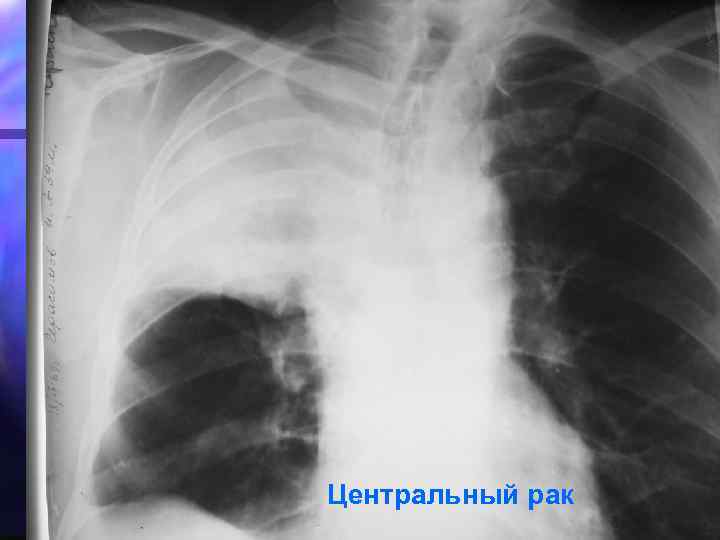 Центральный рак 