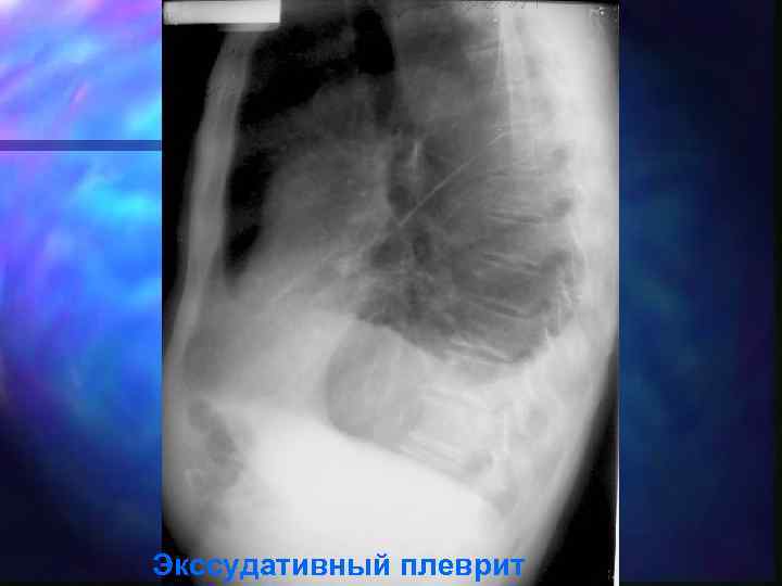 Экссудативный плеврит 