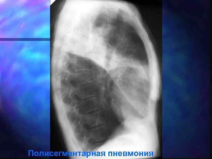 Полисегментарная пневмония 
