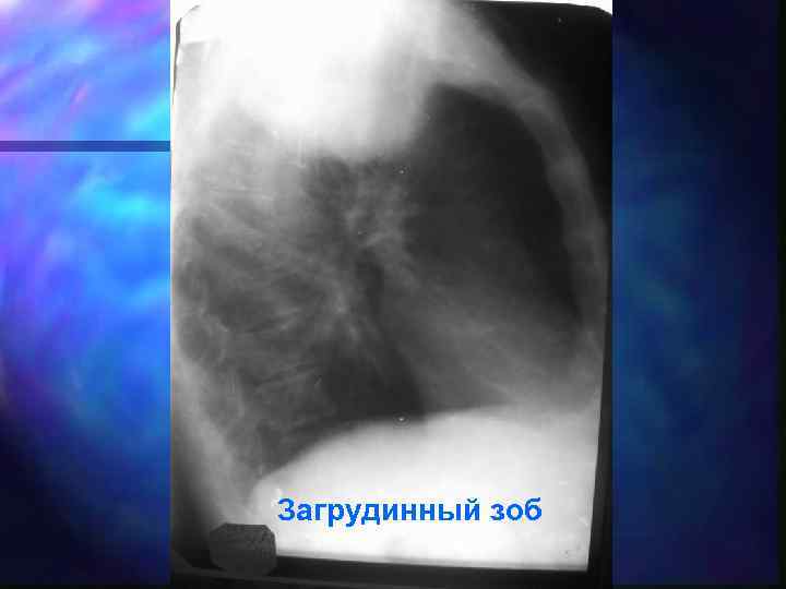 Загрудинный зоб 