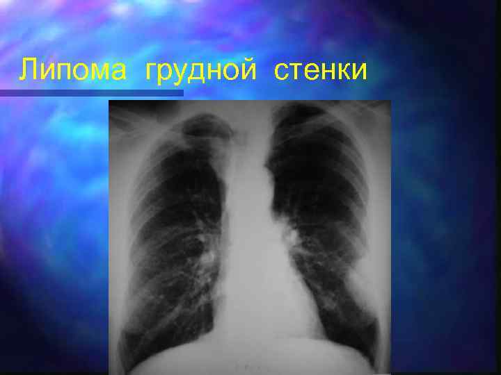 Липома грудной стенки 