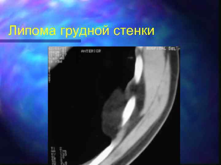Липома грудной стенки 