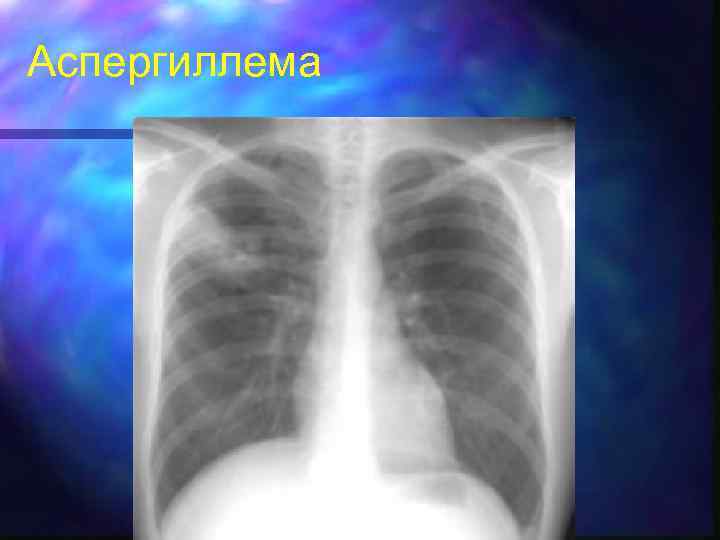 Аспергиллема 