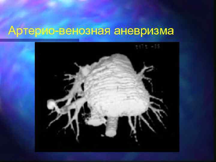 Артерио-венозная аневризма 