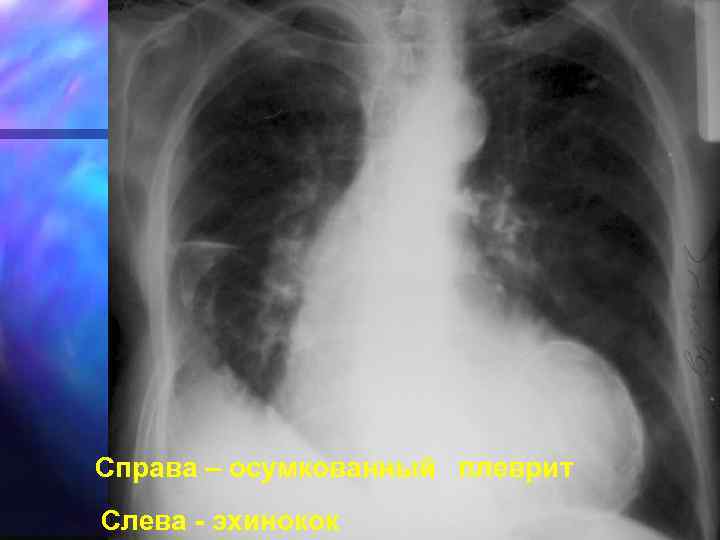 Справа – осумкованный плеврит Слева - эхинокок 