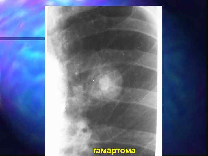 гамартома 