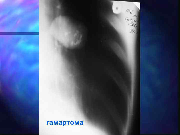 гамартома 