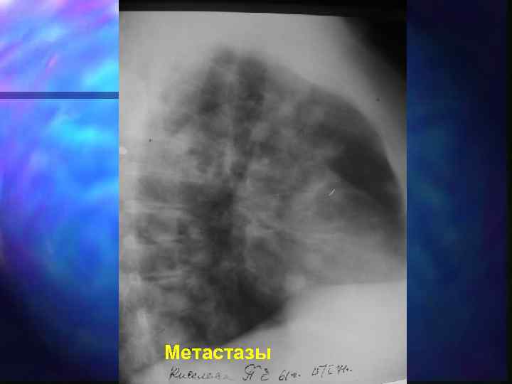 Метастазы 