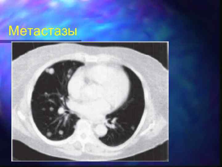 Метастазы 