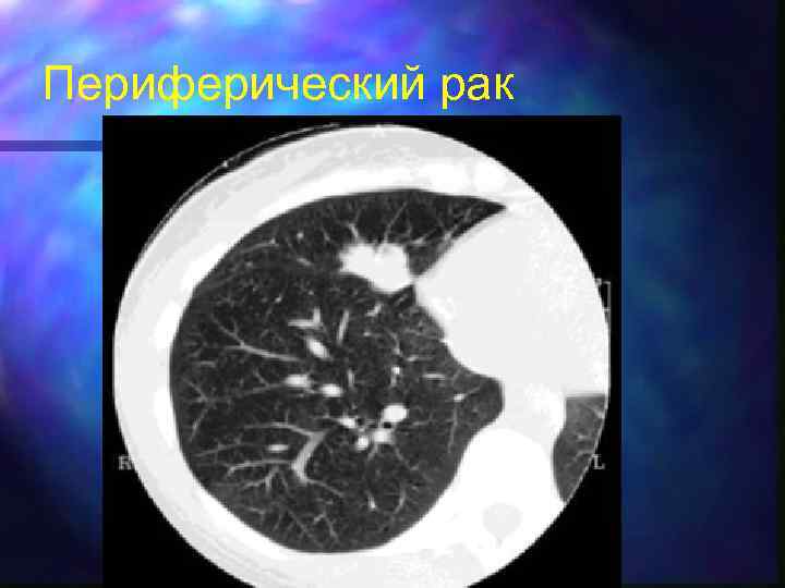 Периферический рак 