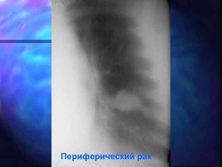 Периферический рак 