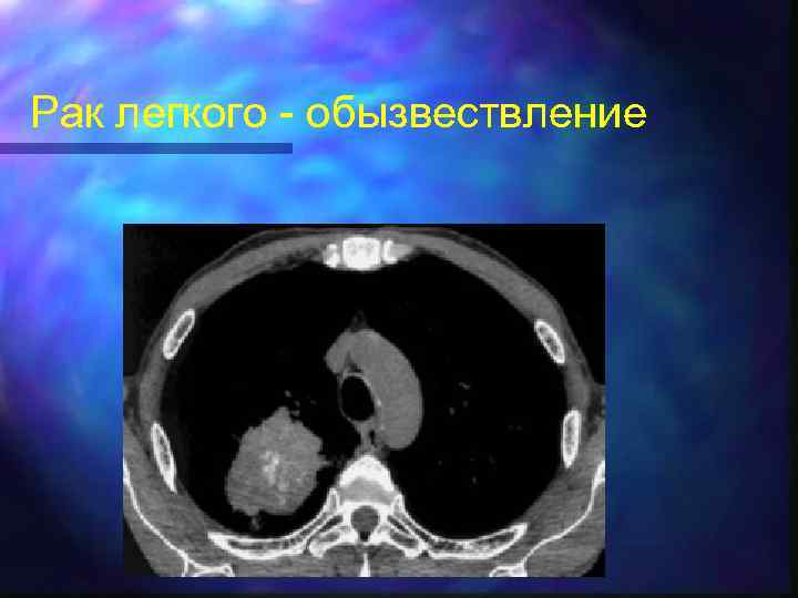 Рак легкого - обызвествление 