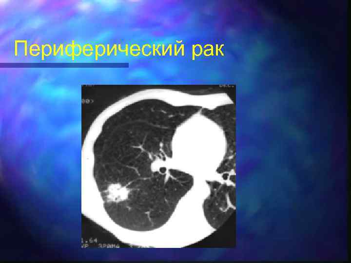 Периферический рак 