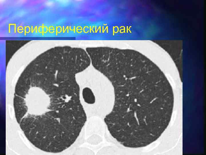 Периферический рак 