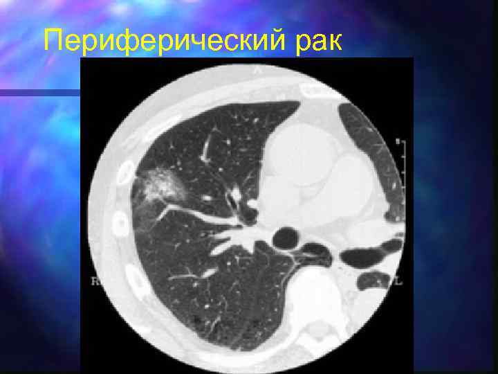 Периферический рак 