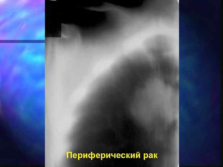 Периферический рак 