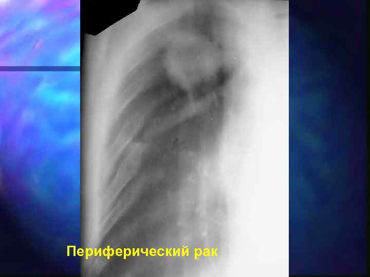 Периферический рак 