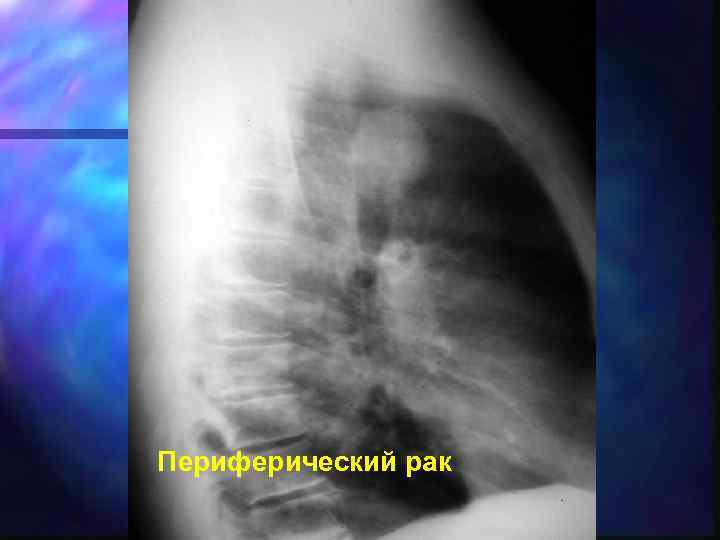 Периферический рак 