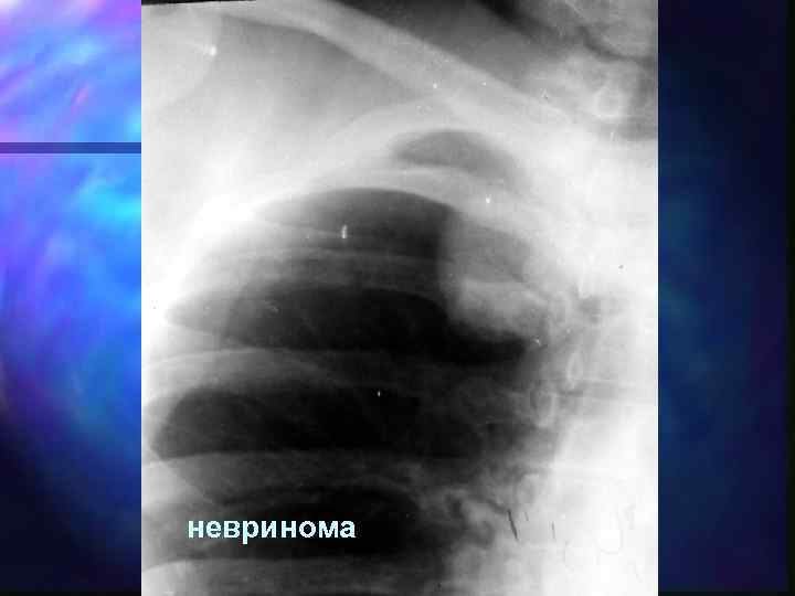 невринома 