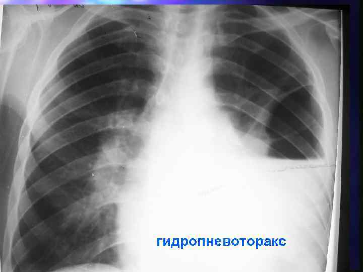 гидропневоторакс 