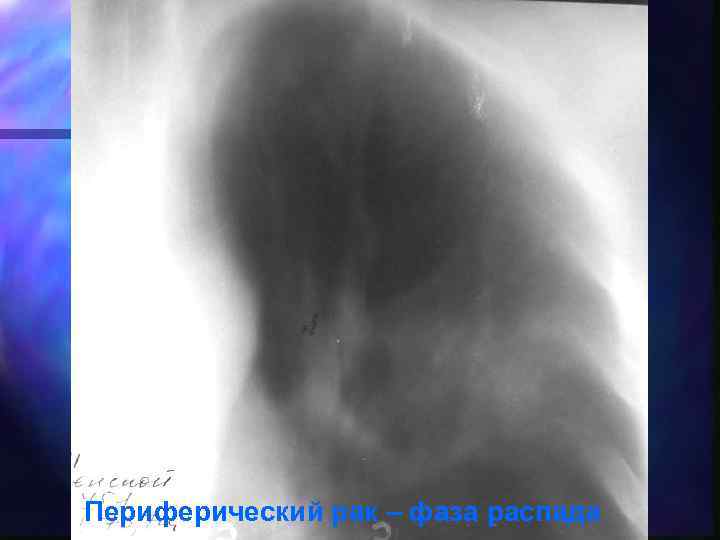 Периферический рак – фаза распада 