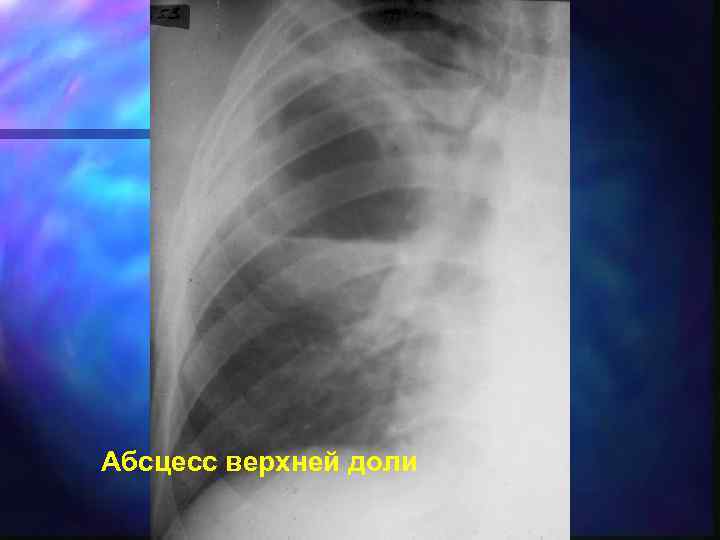 Абсцесс верхней доли 