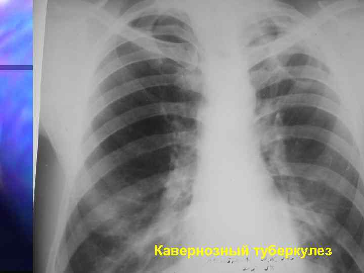 Кавернозный туберкулез 