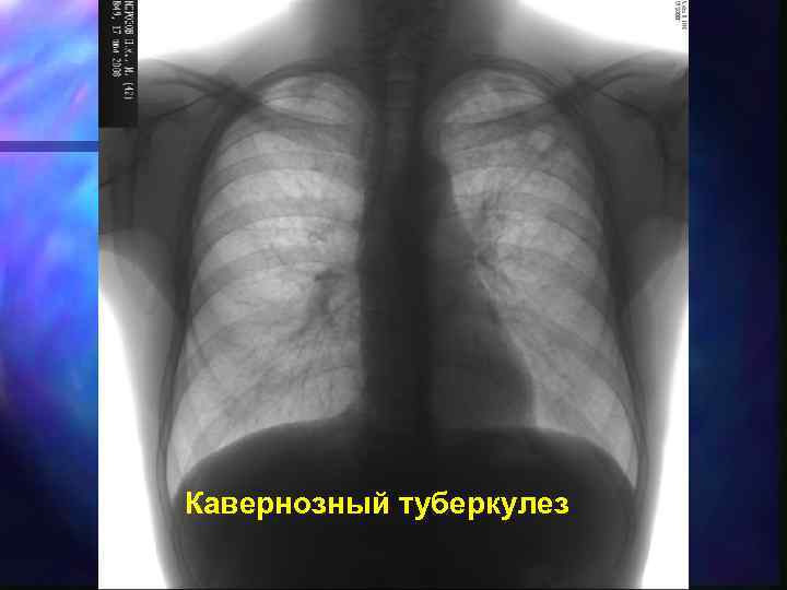 Кавернозный туберкулез 
