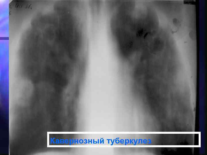 Кавернозный туберкулез 